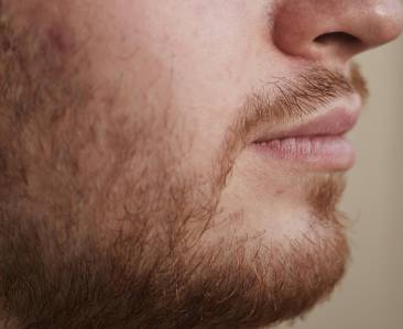 do beards cause acne